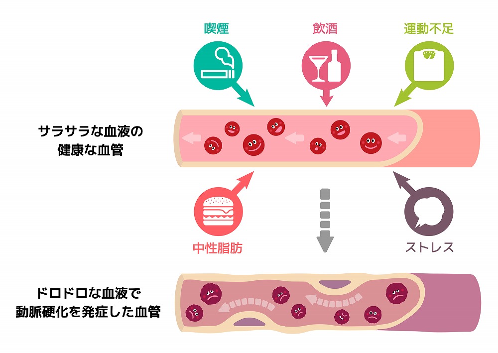 生活習慣病の危険性と知らない間に進む動脈硬化